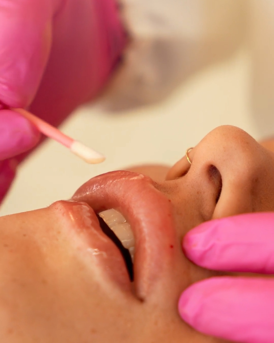 Preenchimento labial em paciente